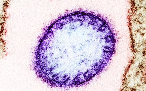 ინდოეთში მომაკვდინებელი Nipah ვირუსის სიმპტომები 11 ადამიანს გამოუვლინდა